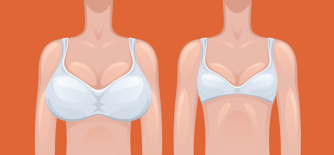Is breast reduction right for you?
