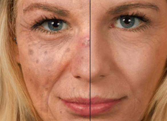 Sunface - Sun Damage Face App
